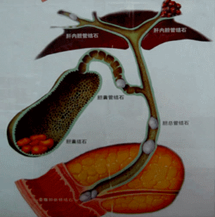 第二节 胆囊结石 大纲要求    (1)临床表现    (2)诊断    (3)胆囊