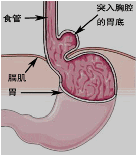 与吞咽无关的下食管括约肌自发性松弛——正常人生理性胃食管反流