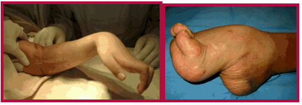 典型畸形是爪形手和爪形足.3.