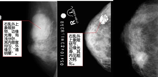 乳房橘皮肤图片凹陷图片