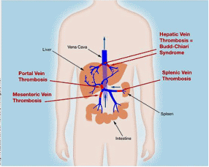3门静脉的栓子——阻塞肝内门静脉及其分支