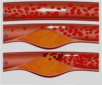 血管内皮损伤继发血栓形成不稳定斑块破溃,继发血栓形成阻塞,导致心肌