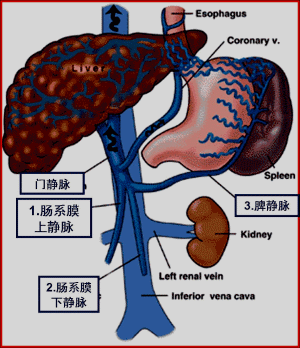 常见病因 肝前型 肝外门静脉血栓形成,先天性畸形,  肝门区肿瘤压迫