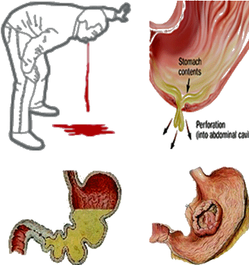 消化性溃疡的并发症图片