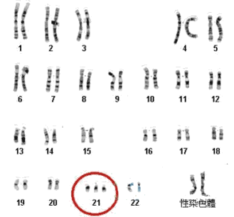 细胞遗传学诊断 标准型 最常见 47,xx(或xy 21 d/g易位