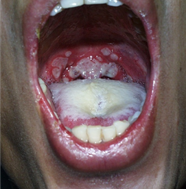 口腔溃疡留下的疤痕图图片