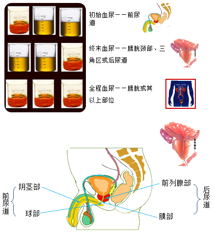 【补充】尿三杯试验